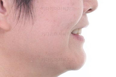 부산옥니교정