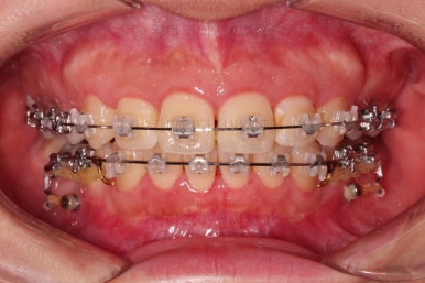 부산무턱교정치과