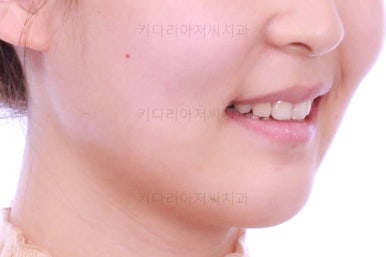 부산클리피씨교정