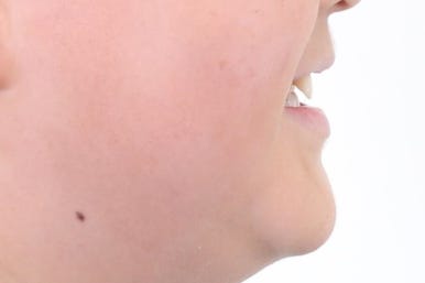 부산비발치교정