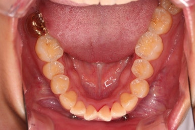 부산앞니부분교정