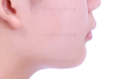 부산어린이치아교정
