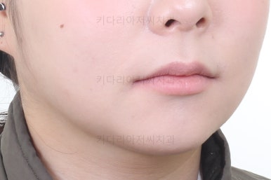 부산연산동교정치과