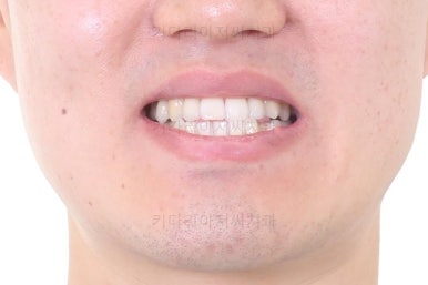 부산비수술교정