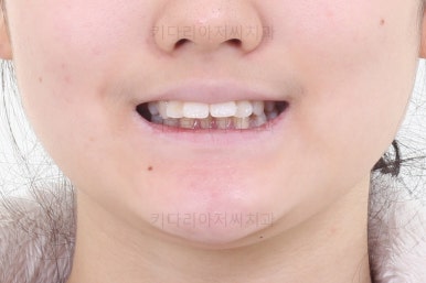 연산동치아교정