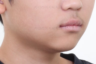 부산어린이돌출입교정