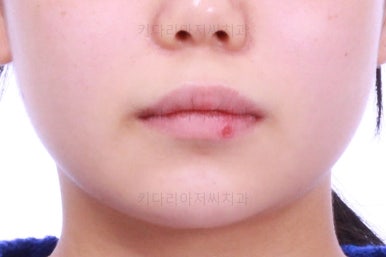 부산앞니벌어짐교정