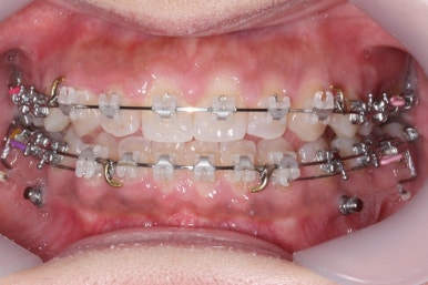 부산치아교정치과