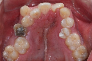 부산구순구개열