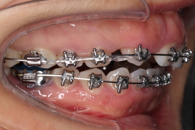 부산구순구개열