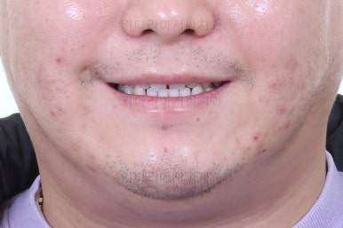 연산동임플란트