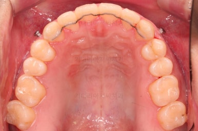 부산긴얼굴긴턱교정