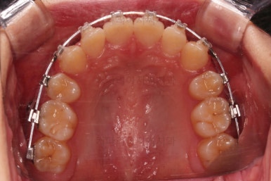 부산돌출입교정