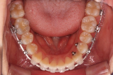 부산치아교정잘하는곳