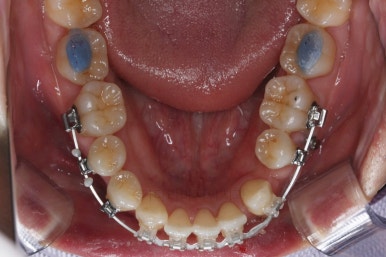 부산비수술교정