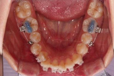 부산클리피씨교정