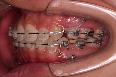 부산청소년치아교정