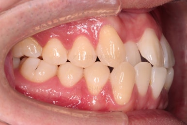 부산인비절라인