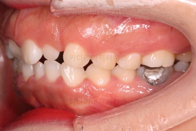 부산구순구개열