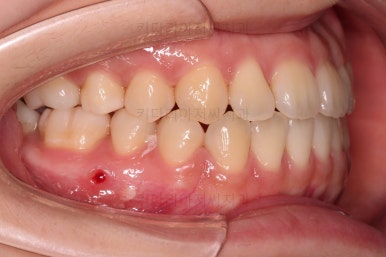 부산치아교정추천