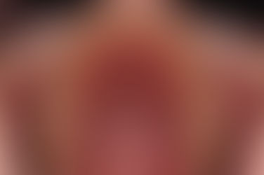 부산덧니교정