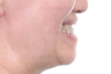 부산치아교정잘하는곳