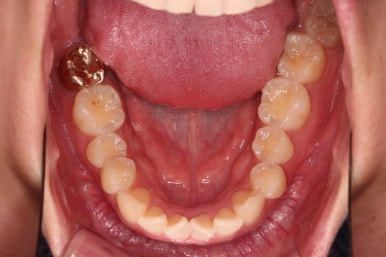 부산앞니부분교정