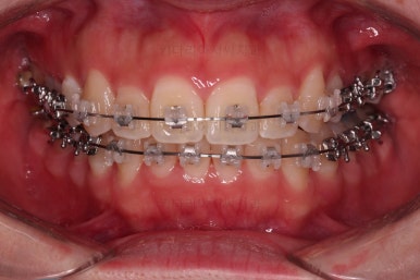 부산비대칭교정