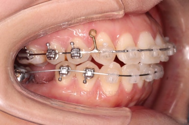 부산사랑니교정
