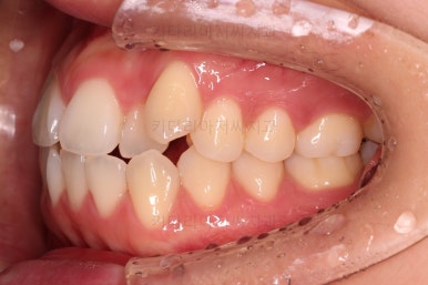 부산비발치교정