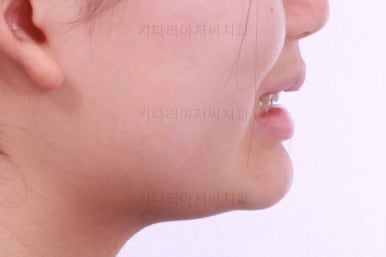 부산어린이치아교정