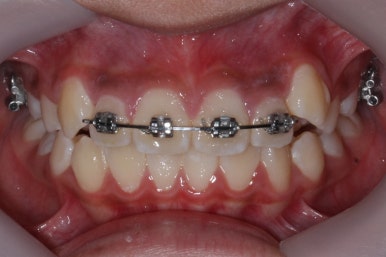 연산동덧니교정