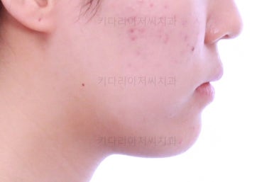 부산비발치교정