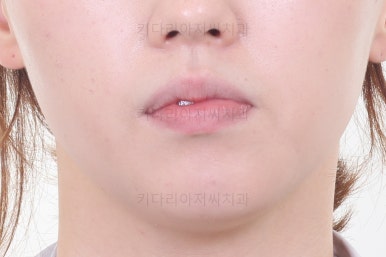 부산비대칭교정