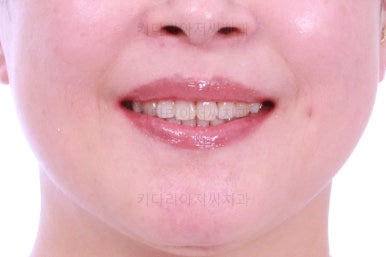 동래임플란트교정