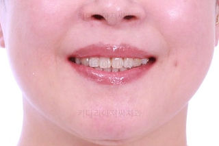 동래임플란트교정