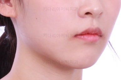 부산클리피씨교정