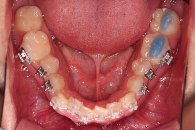부산긴얼굴긴턱교정