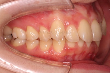 부산돌출입교정