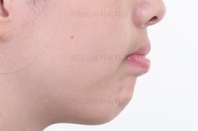 부산투명교정