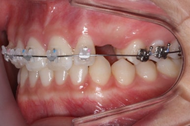 부산매복치아교정