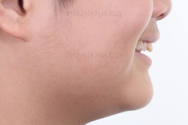 부산성장기교정