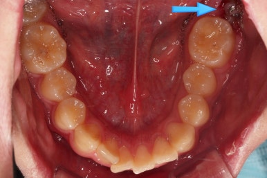 부산연산동사랑니발치