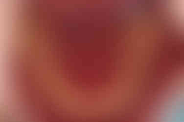 부산연산동사랑니발치