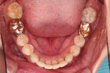 부산치아교정비용