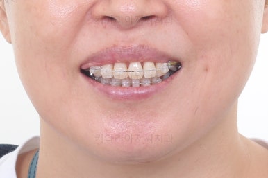 동래임플란트교정