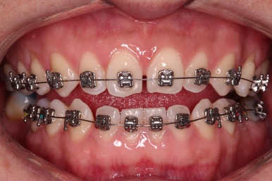 연산동임플란트