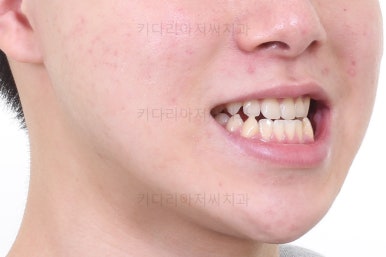 부산주걱턱교정