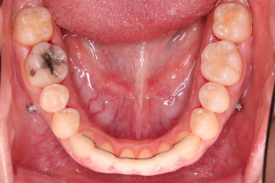 부산비발치교정
