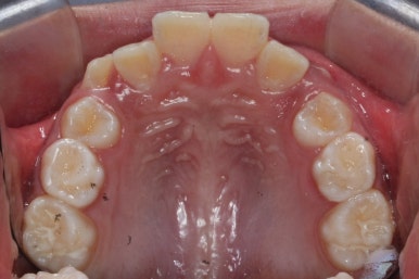연산동덧니교정